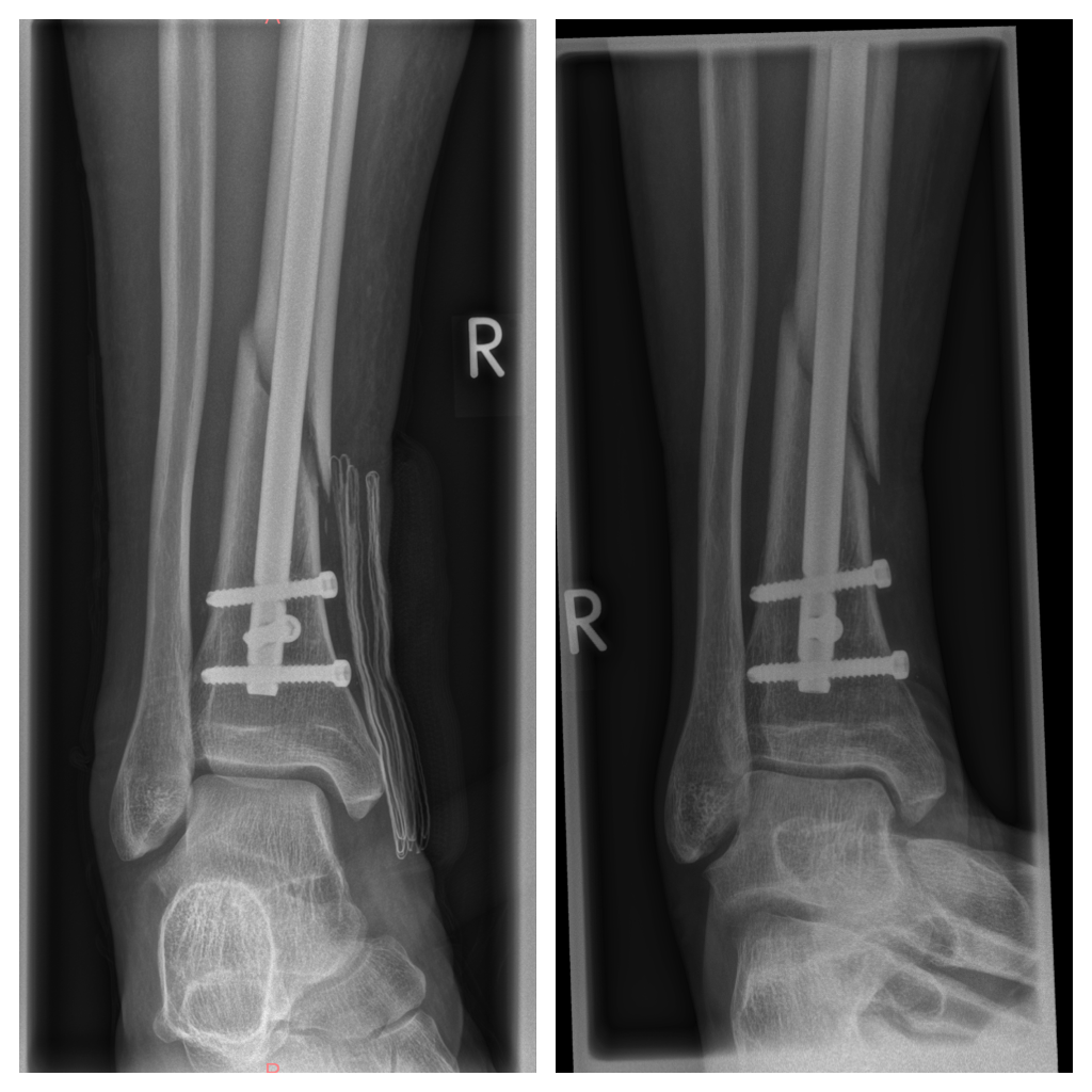 Röntgenbilder: links: direkt nach der OP, rechts: 8 Wochen später